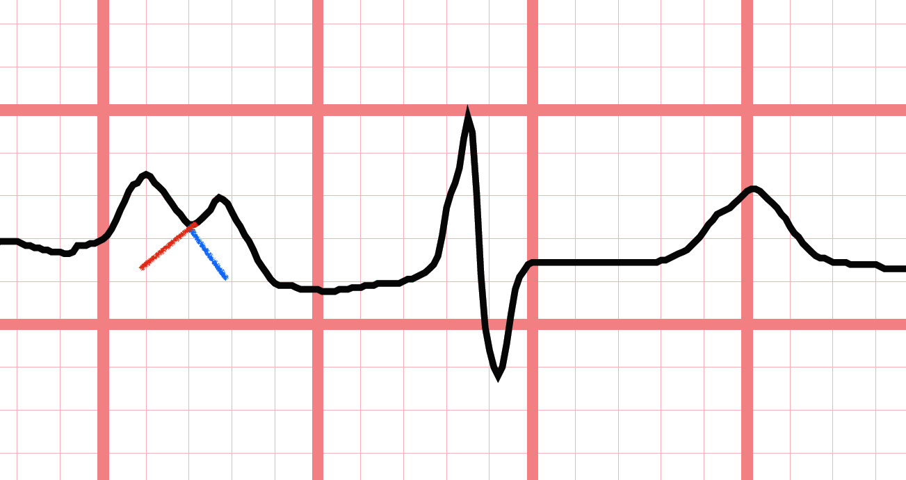 here-are-2-examples-of-m-shaped-p-waves-in-lead-ii